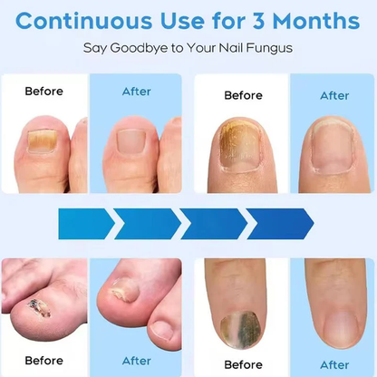 Nail Fungus Laser